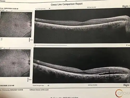 ЦСР до и после микрофотокоагуляции