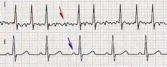 ЭКГ фибрилляции предсердий (верхний) и нормального синусового ритма (нижний). Фиолетовая стрелка указывает на зубец P, который отсутствует при аритмии.