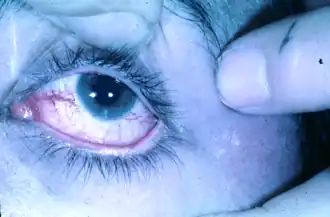 Глазная телеангиэктазия при синдроме атаксии-телеангиэктазии