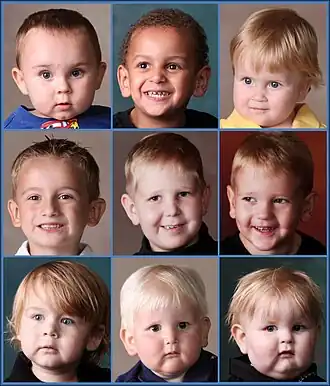 "ангельский" вид детей с синдромом Барта