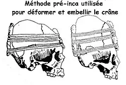 Метод деформации черепа, применяемый в культуре Паракас и Инков