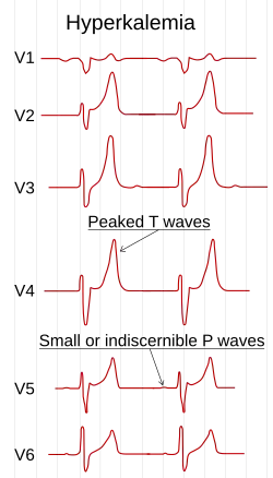 Электрокардиограмма, которая показывает изменения в грудных отводах при гиперкалиемии