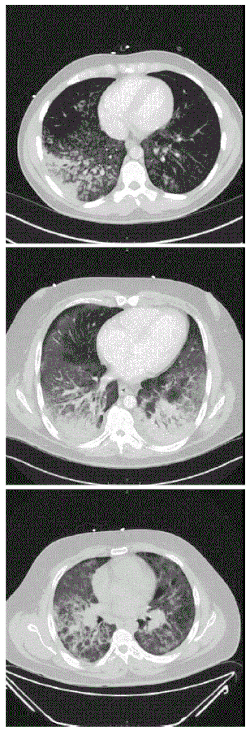 Изображения компьютерной томографии, показывающие диффузные инфильтраты в лёгких у трёх пациентов, 2019 год
