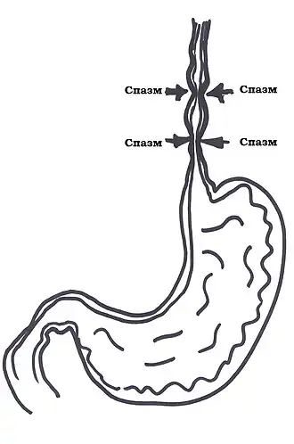 схематическое изображение спазма пищевода