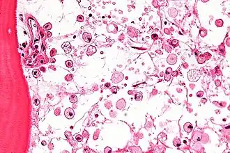 На микрофотографии характерные изменения строения костного мозга при болезни Гоше — цитоплазма макрофагов напоминает смятую папиросную бумагу. Окраска гематоксилином и эозином