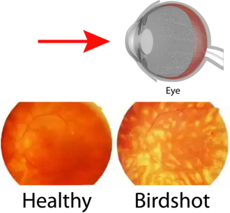 Характерная гиперпигментация при дробьевидной хориоретинопатии