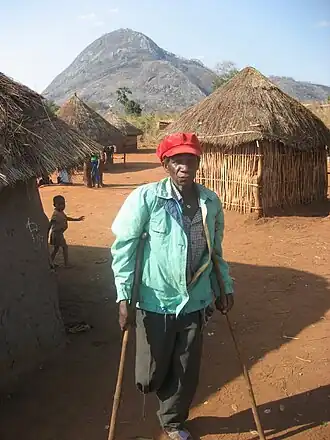 Жертва противопехотных мин, установленных во время войны.