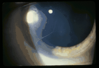 Видны утолщённые нервные волокна роговицы пациентки с МЭН—IIb.