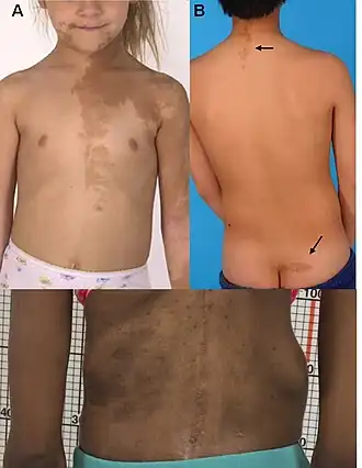 Гиперпигментация кожи.A) Типичное поражение на лице, груди и руке 5-летней девочки с синдромом Мак-Кьюна — Олбрайта, демонстрирующее неровные границы и тенденцию к сохранению средней линии и следованию линиям развития Бласчко.Б) Типичные поражения, которые часто встречаются на задней части шеи и в складке ягодиц, показаны (чёрные стрелки).В) Типичное поражение на нижней части спины у взрослого с синдромом Мак-Кьюна — Олбрайта демонстрирует неровные границы (белая стрелка). Обратите внимание на асимметрию позвоночника из-за сколиоза, вызванного фиброзной дисплазией.