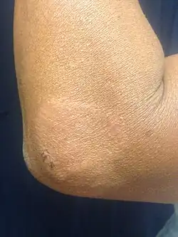 Пауцибациллярная лепра (PB): Бледный участок кожи с потерей чувствительности.