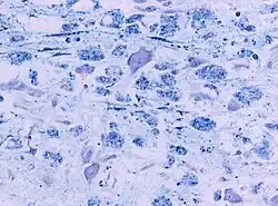 Pontine myelinolysis myelinophages