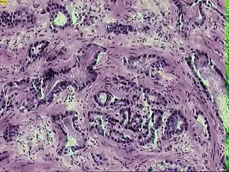 Микрофотография инвазивной аденокарциномы простаты