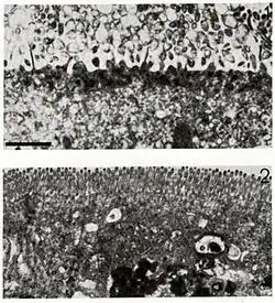 Микрофотография наверху изображает заражённую клетку с разрушенной мембраной, внизу — здоровую клетку.