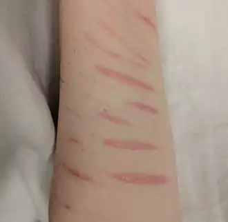 Зажившие после нанесения порезов шрамы