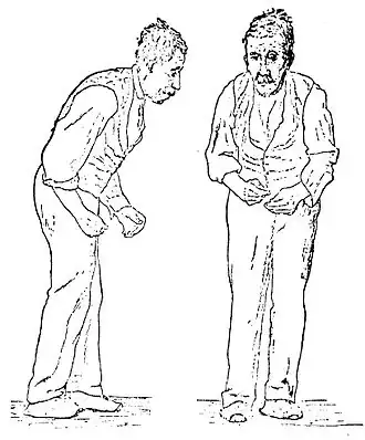 Пациент с болезнью Паркинсона. Рисунок из руководства 1886 года Уильяма Говерса