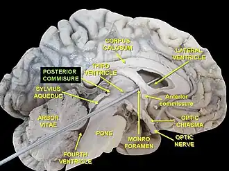 Задняя комиссура, отмеченная в головном мозге человека.
