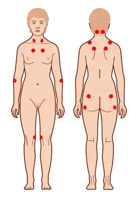 Рис. 1. Расположение чувствительных точек при фибромиалгии