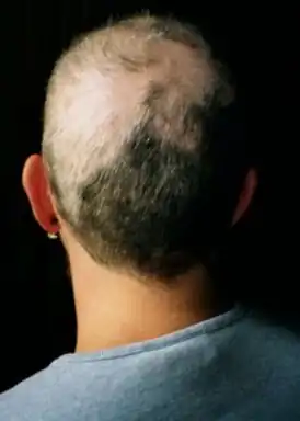 Неполная утрата волосяного покрова головы у больного трихотилломанией