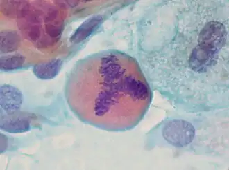 Трёхполюсный митоз в препарате бронхоальвеолярного лаважа.