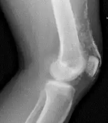 Рентгенограмма коленного сустава пациента с дерматомиозитом.