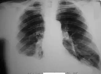 Закрытые переломы VI, VII, VIII, IX рёбер справа. Правосторонний гемоторакс