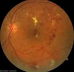 Диабетическая ретинопатия