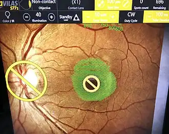 Цифровой план навигационной коагуляции