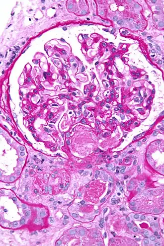 Микрофотография биоптата почки при острой тромботической микроангиопатии, вызванной ДВС-синдромом. Тромб находится в воротах клубочков (центр изображения).