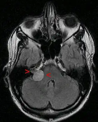 МРТ головного мозга. Невринома слухового нерва указана стрелками