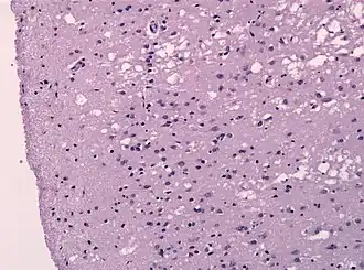 Гистологический препарат — ткань лобной доли головного мозга больного болезнью Крейтцфельдта — Якоба