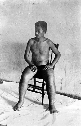 Больной бери-бери в Юго-Восточной Азии