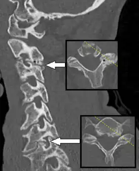 КТ Спондилёза, вызывающий радикулопатию