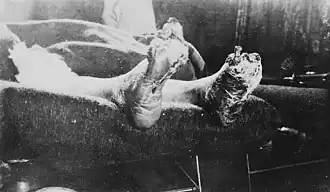 Неизвестный французский солдат, страдающий от траншейной стопы (1917 год)