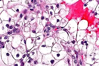 Типичная гистологическая картина светлоклеточного рака почки в высоком разрешении. Окраска гематоксилином и эозином.
