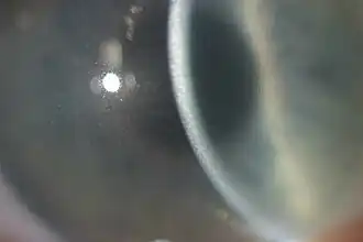 Прозрачность роговицы особенно сильно нарушена в верхней части стромы, как показывает осмотр с помощью щелевой лампы