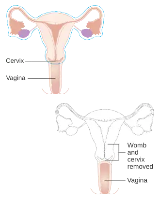 Части тела, которые удаляются при радикальной гистерэктомии