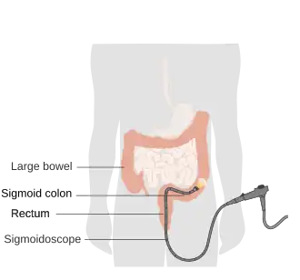 Схема ректороманоскопии при помощи эндоскопического оптоволоконного ректороманоскопа