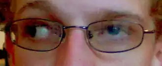 Офтальмоплегия при синдроме Штиллинга-Тюрка-Дуэйна — врождённый, чаще односторонний паралич прямых мышц глазного яблока.