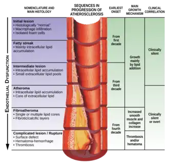 Изменения в сосуде (процесс развития атеросклероза), накапливание холестерина