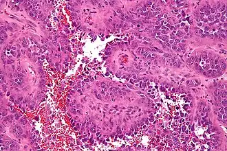 Микрофотография ангиосаркомы. Окрашено гематоксилином и эозином.