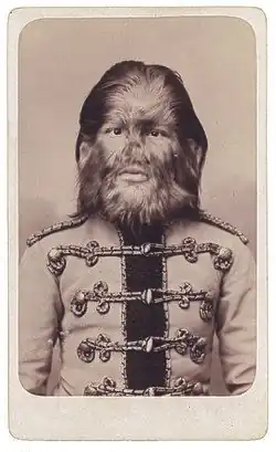 Фёдор Адрианович Евтихиев, один из самых известных людей, страдавших гипертрихозом