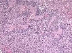 Псевдорозетки наблюдаются вокруг некроза при глиобластоме