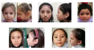 Пять испаноязычных девочек и женщин с синдромом Тёрнера