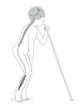 Схематическое изображение нарушения функций при парезе