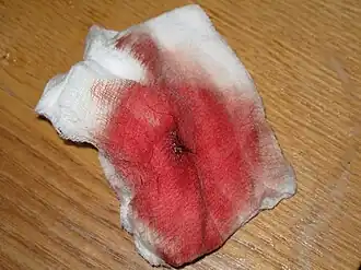 Кровохарканье