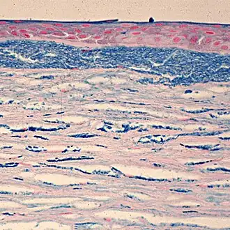 Окрашивание на гликозаминогликаны отчётливо выявляет изменения структуры роговицы - отложения внутри кератоцитов и во внеклеточном пространстве под эпителием