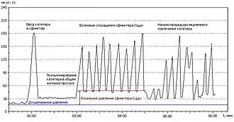 Условный график давления при манометрии сфинктера Одди