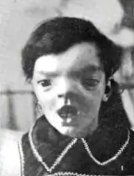 Глазной гипертелоризм у семилетней девочки (не следует путать с телекантом[англ.])