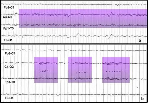 Примеры паттернов мю-ритма: а) непрерывный мю-ритм, b) отдельные всплески