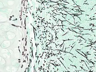 Гистопатологическая картина инвазивного аспергиллёза лёгких у пациента с интерстициальной пневмонией. Аутопсийный материал.